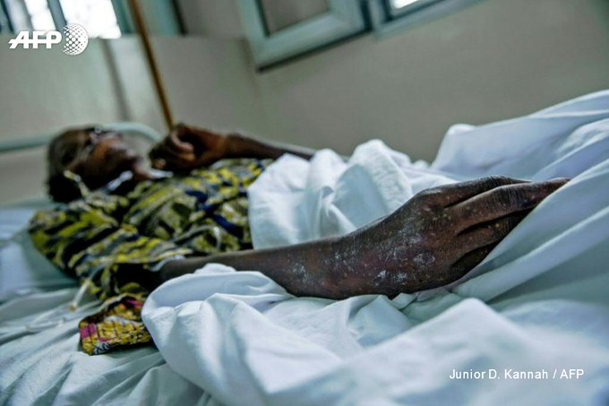 UNAIDS  เผยผู้เสียชีวิตจากเอดส์ลดลงเกือบครึ่ง-ได้รับยาต้านไวรัสแล้ว 19.5 ล้านคน