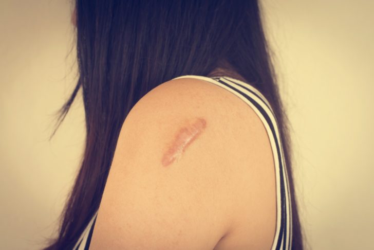 Skin lesions from allergies. Vintage filtered image.
