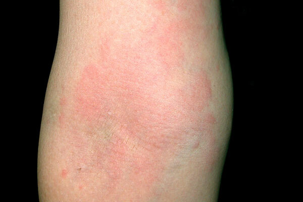 10 สาเหตุ โรคลมพิษ (urticaria) ที่คุณควรรู้