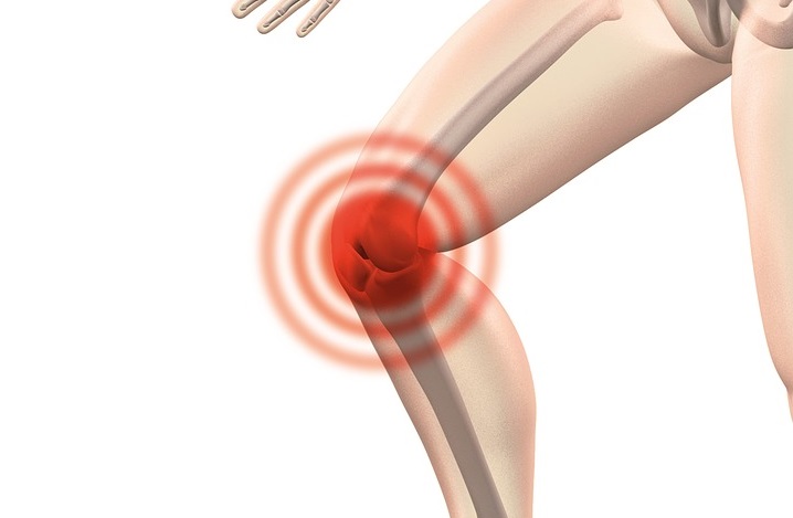 arthrocalman-2384253_960_720