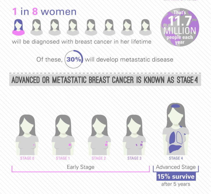 Breast Cancer - ระยะการเกิดโรคมะเร็งเต้านม