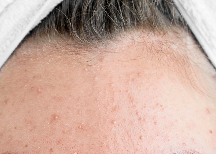 Girl after spa in white towel with acne problem skin puberty period problem face care