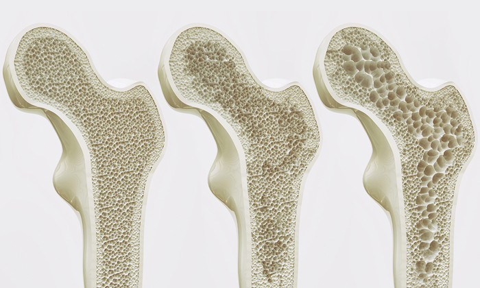 โรคกระดูกพรุน: ผู้ป่วยควรดูแลตัวเองอย่างไร?
