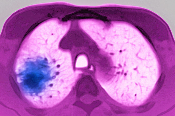 Lung cancer MRI.