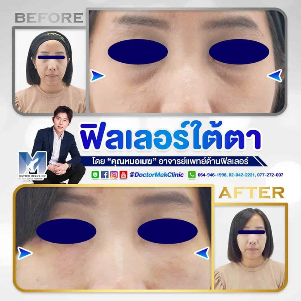 แก้ปัญหาใต้ตาลึก หมองคล้ำดูโทรม ได้อย่างตรงจุด ด้วยการเลือกฉีดฟิลเลอร์ใต้ตา