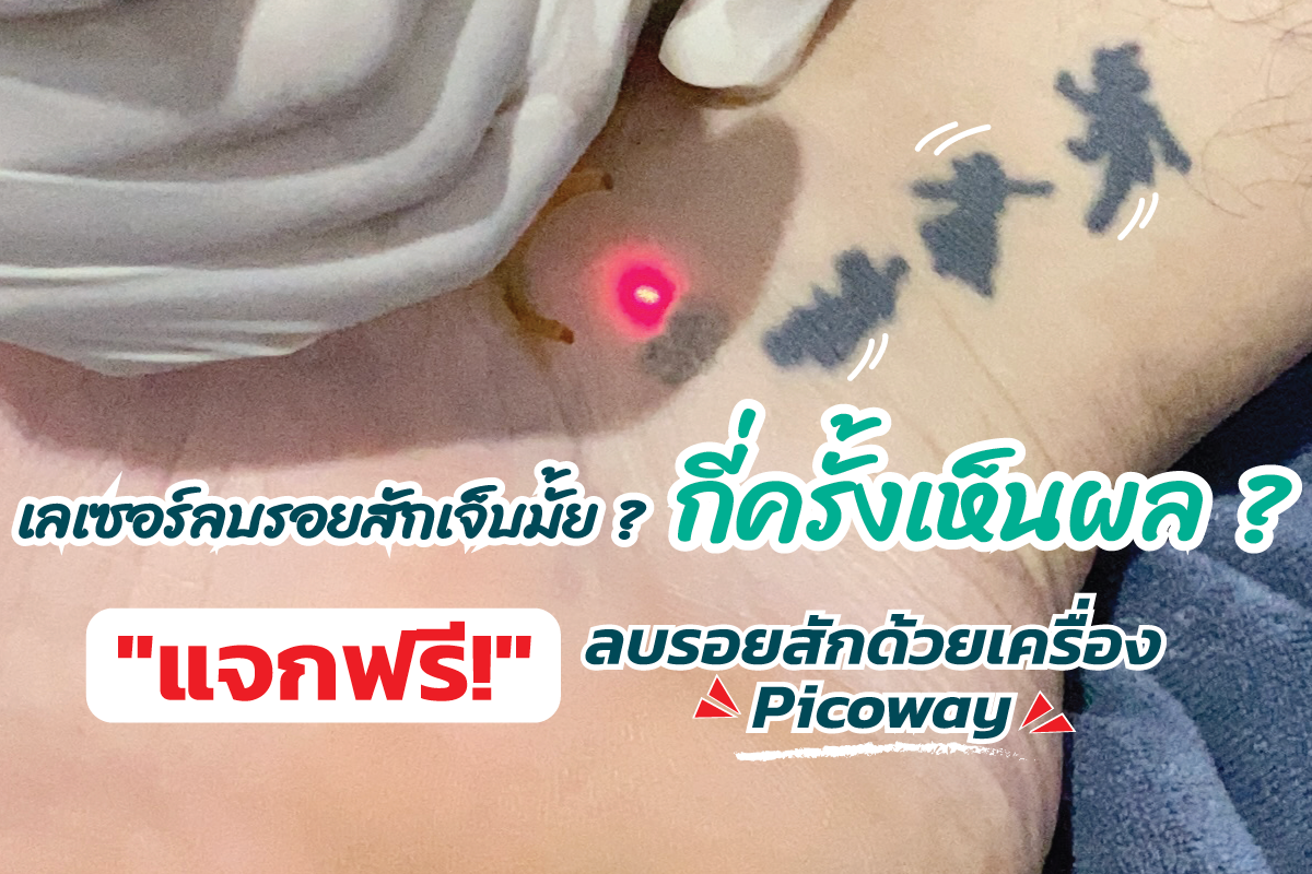 ลบรอยสักด้วยเซอร์รอยหายจริงไหม? คุ้มค่าที่จะทำหรือไม่ ? มาหาคำตอบกันที่นี่