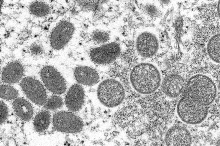 Monkeypox ฝีดาษลิง