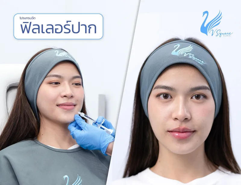 ฟิลเลอร์ปาก