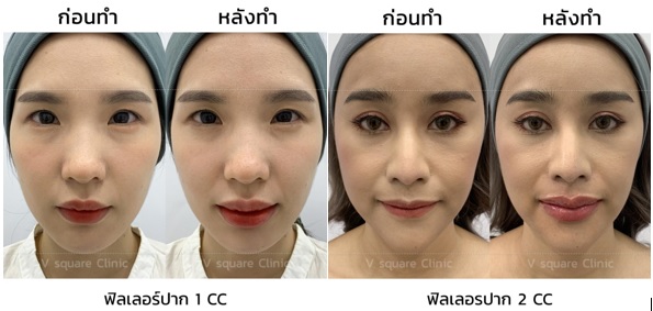 รีวิวฉีดปาก 1 cc และ 2 cc