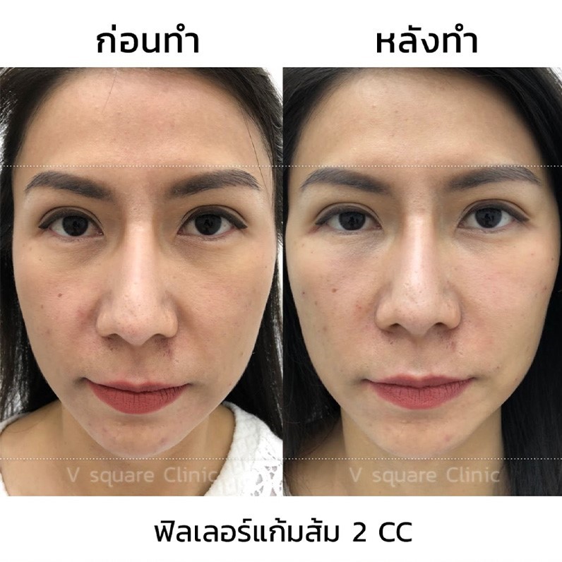 ฉีดฟิลเลอร์แก้มส้ม