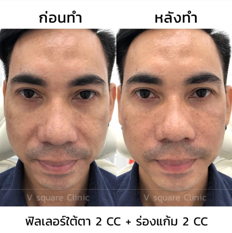 ฉีดฟิลเลอร์ร่องแก้มรีวิว 2 cc ฉีดฟิลเลอร์ร่องแก้มรีวิว 2 cc
