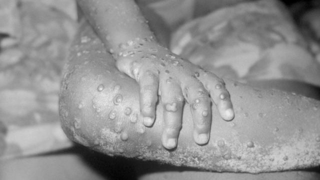 แขนและขาของเด็กหญิงวัย 4 ขวบที่ติดเชื้อโรคฝีดาษลิงในไลบีเรีย