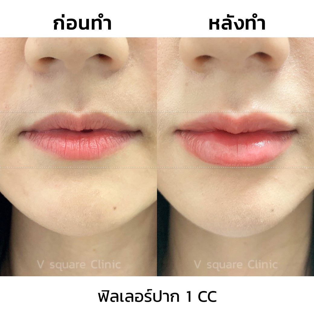 รีวิวฉีดฟิลเลอร์ปาก