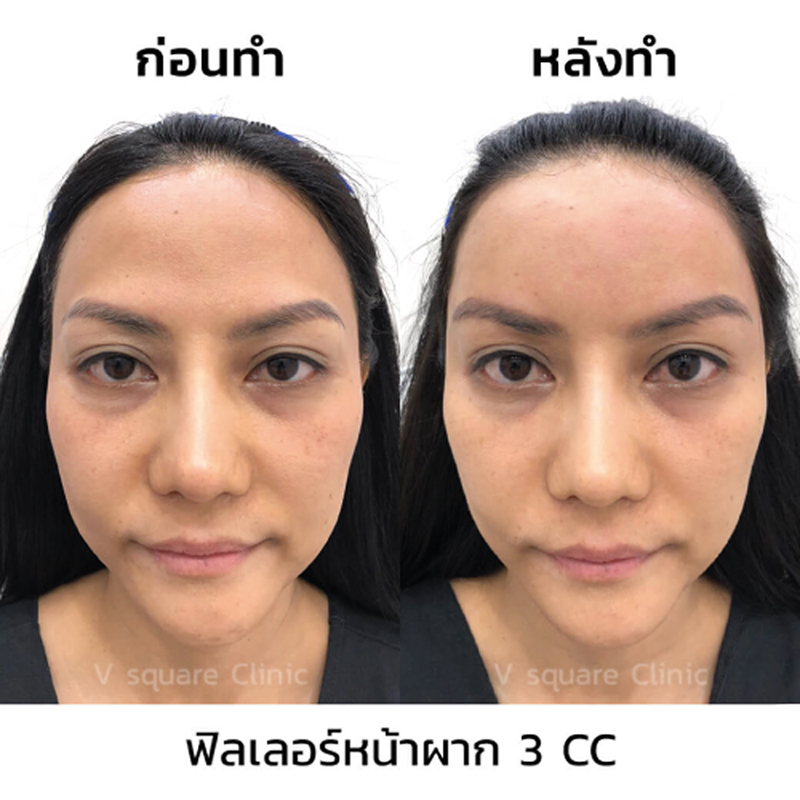 รีวิวฉีดฟิลเลอร์หน้าผาก1