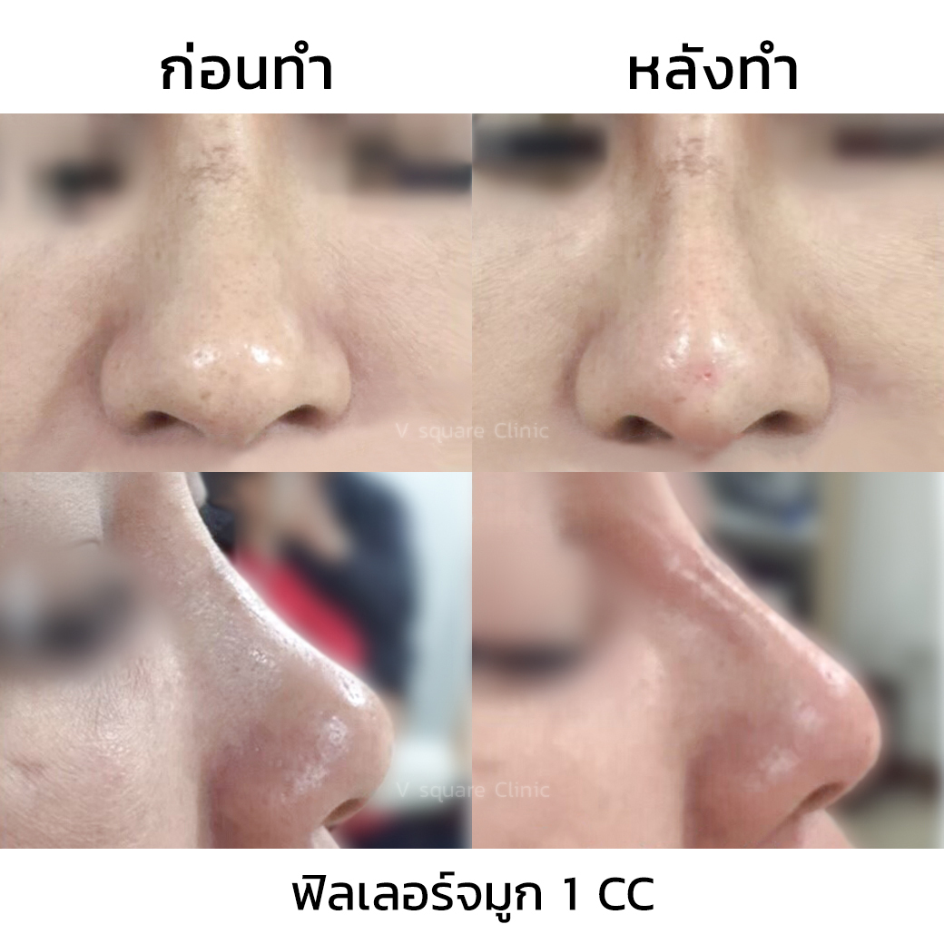 ฉีดฟิลเลอร์จมูก