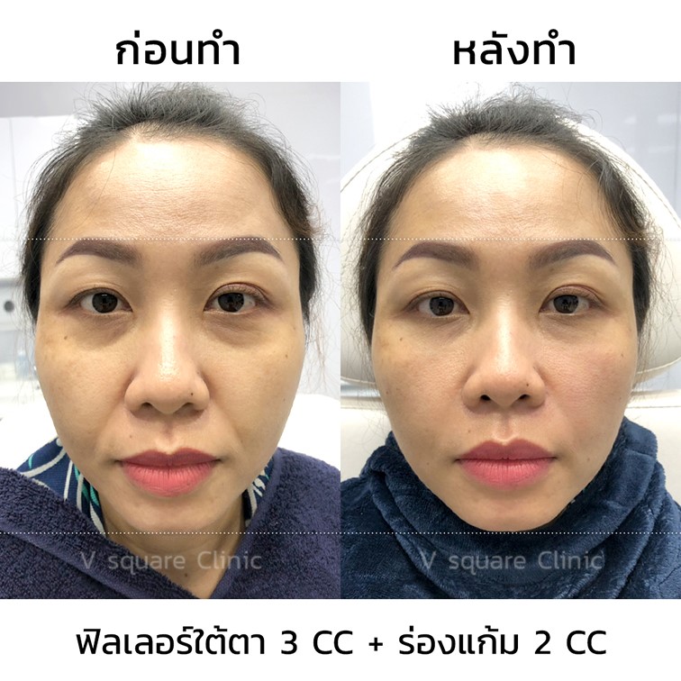 รีวิว ฉีดฟิลเลอร์ร่องแก้ม 2 cc รีวิว ฉีดฟิลเลอร์ร่องแก้ม 2 cc
