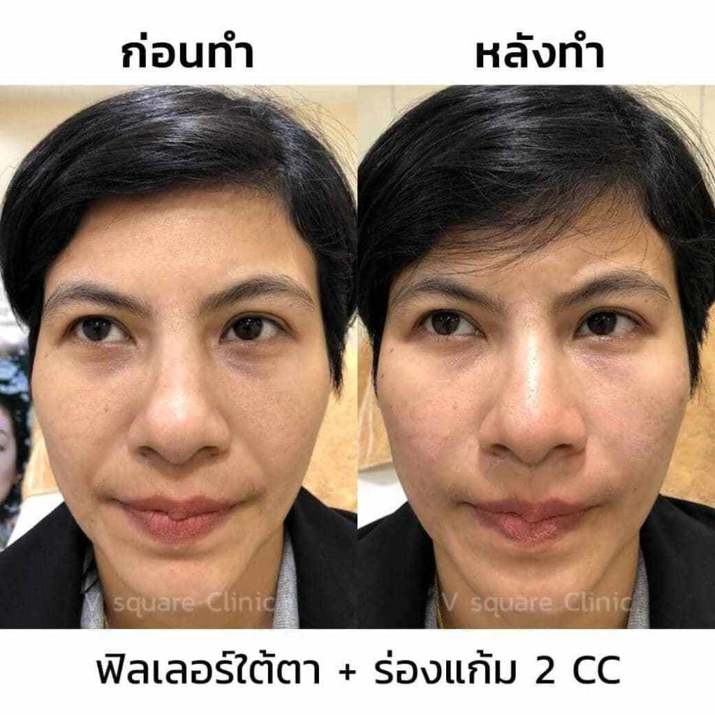 รีวิว-ฉีดฟิลเลอร์ร่องแก้ม 2 cc รีวิว-ฉีดฟิลเลอร์ร่องแก้ม 2 cc
