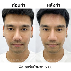 ฉีดฟิลเลอร์หน้าผาก รีวิว1 