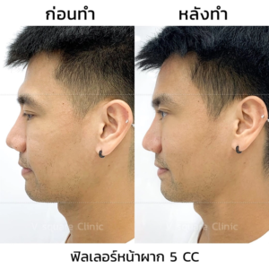 ฉีดฟิลเลอร์หน้าผาก รีวิว2