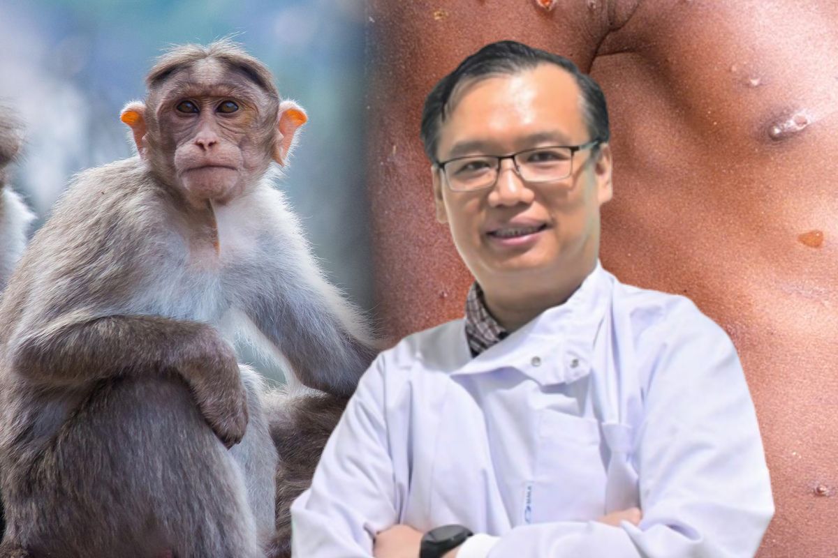 ฝีดาษลิงในไทยมี 1 ราย ดร.อนันต์ ขออภัยทำสับสน พร้อมแจงสาเหตุ