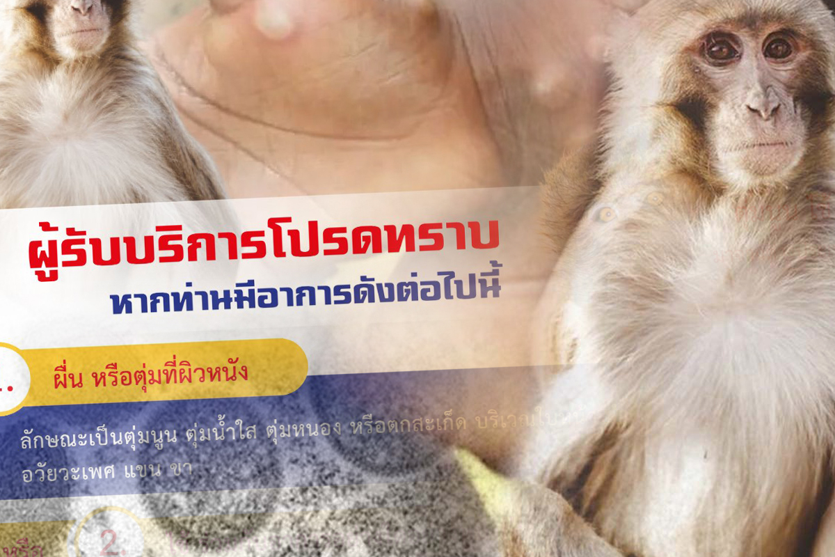 ฝีดาษลิงรายที่ 2 รักษา รพ.วชิระ เข้มผู้ใช้บริการมีอาการเข้าข่ายแจ้งพยาบาลทันที