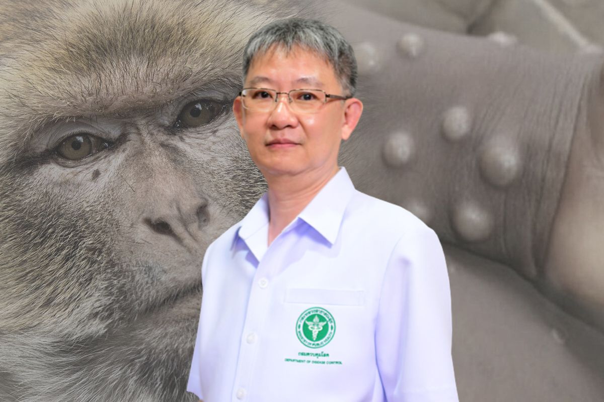 สธ.เผย เริ่มจัดหาวัคซีนฝีดาษวานรแล้ว