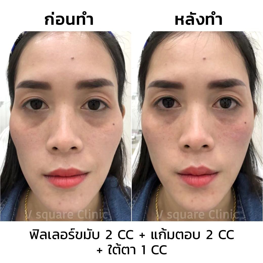 รีวิว ฟิลเลอร์ขมับ 2 CC