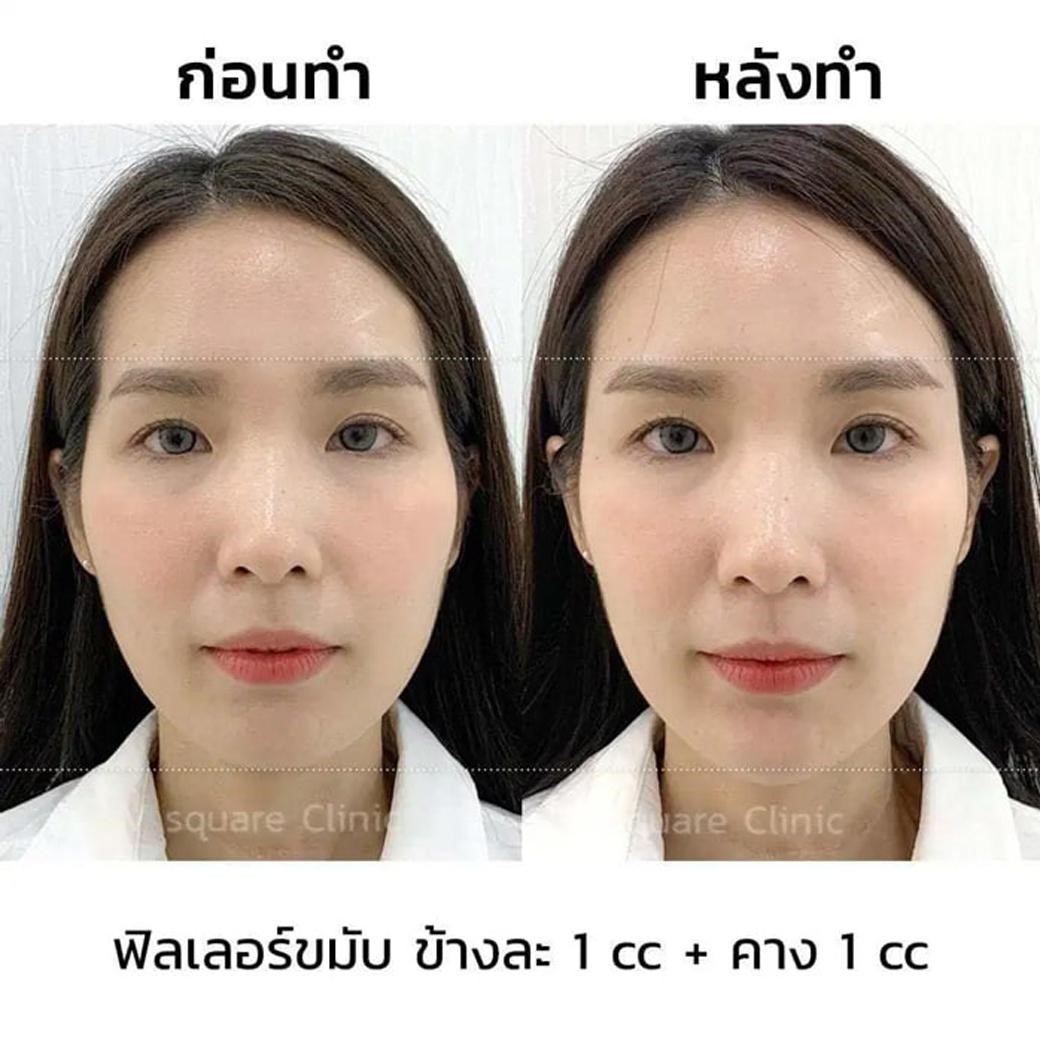 รีวิว ฟิลเลอร์ขมับข้างละ 1 CC
