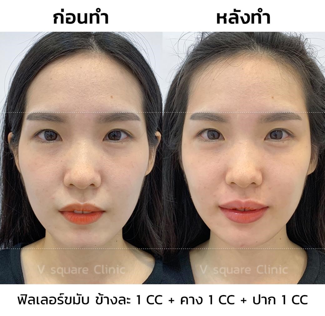รีวิว ฟิลเลอร์ขมับข้างละ 1 CC