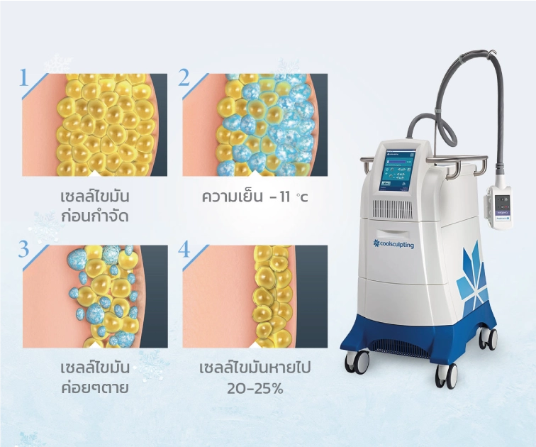 Coolsculptingคืออะไร Coolsculptingคืออะไร