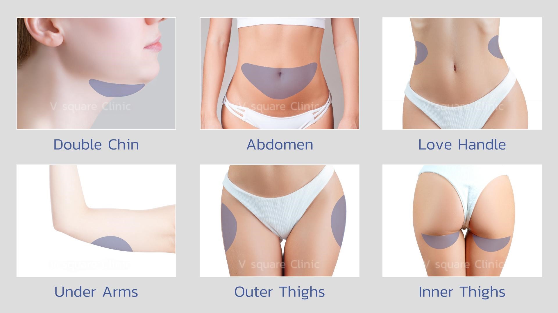 Thermage FLX ทำตำแหน่งไหนบ้าง