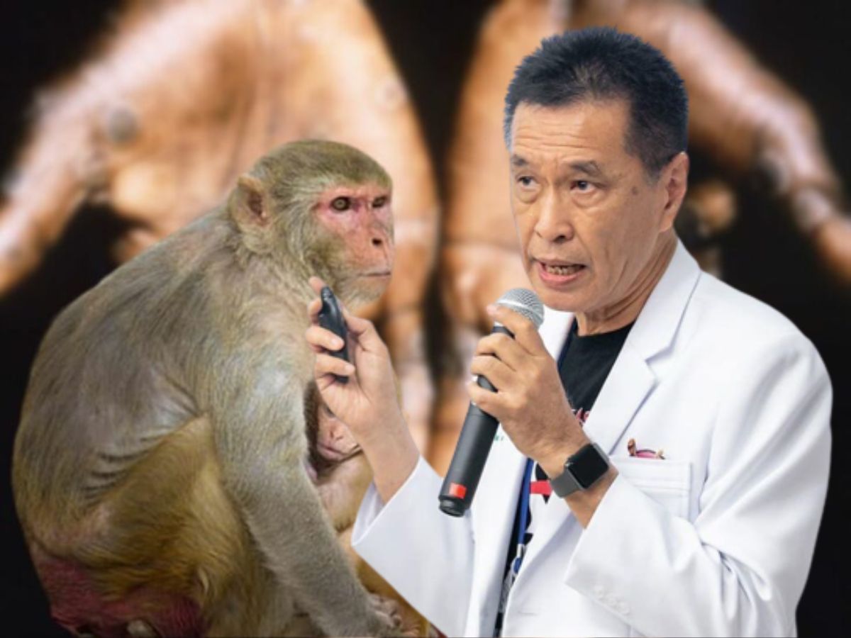 หมอธีระวัฒน์​แนะใช้การแยงจมูกเก็บน้ำลายตรวจฝีดาษลิง