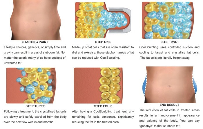 กระบวนการทำงาน CoolSculpting กระบวนการทำงาน CoolSculpting