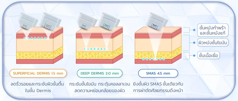 การทำงานของ Ulthera