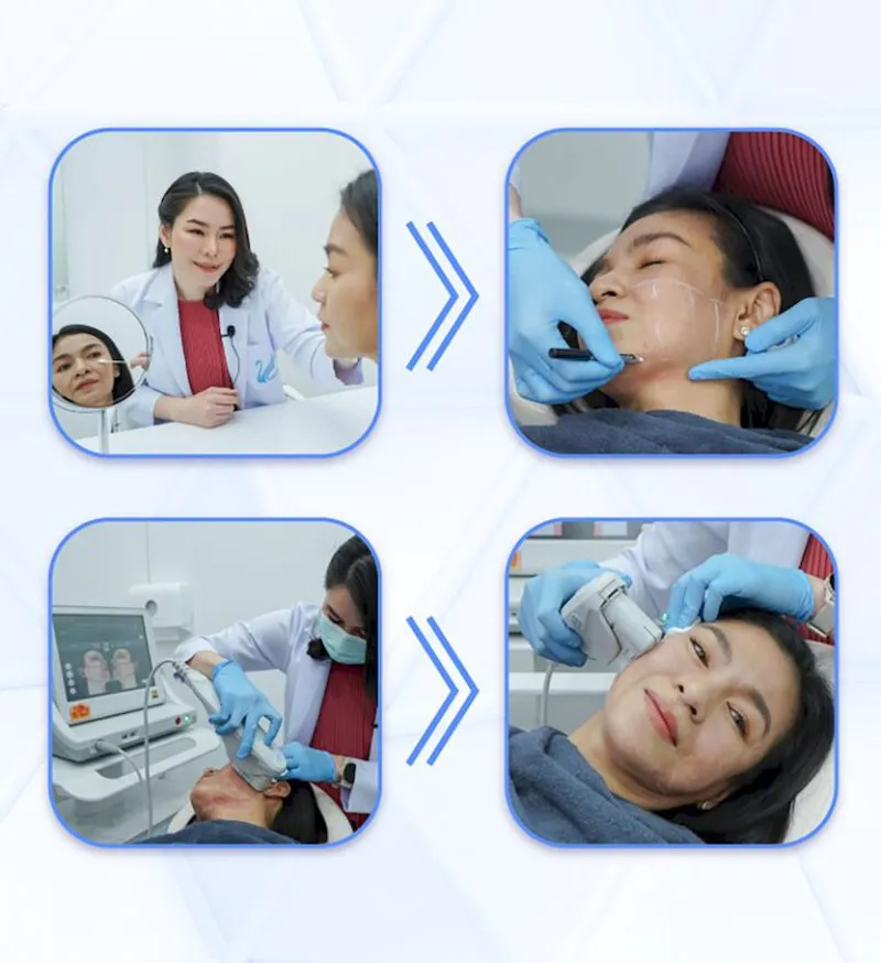ขั้นตอนการทำ Ulthera