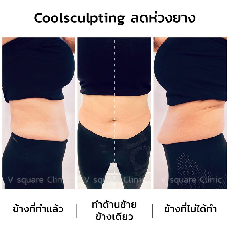 ตัวอย่างรีวิวCoolsculpting ตัวอย่างรีวิวCoolsculpting