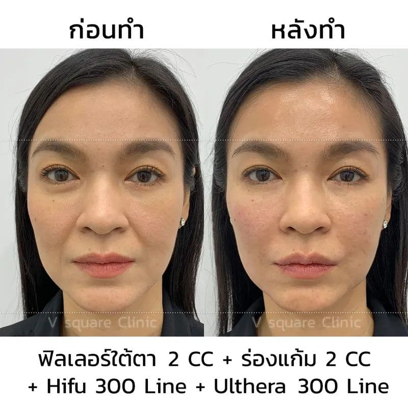 รีวิวการทำ Ulthera1