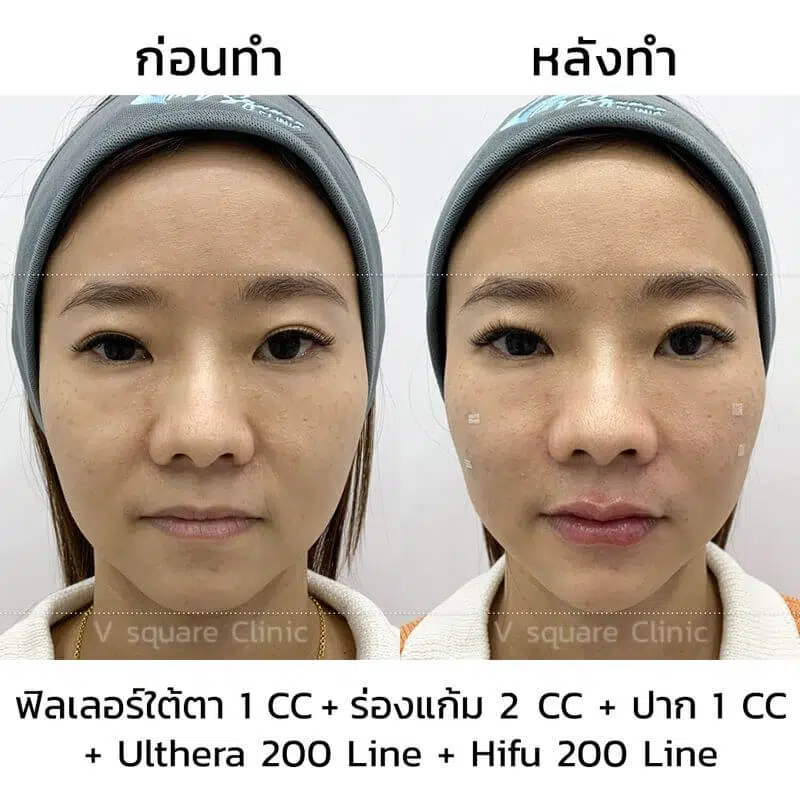 รีวิวการทำ Ulthera2