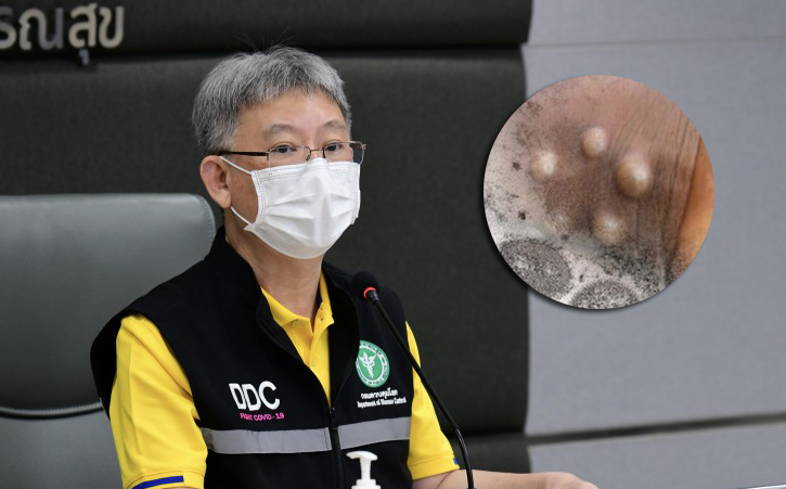 สธ. ลดระดับศูนย์ EOC ฝีดาษลิง หลังแนวโน้มผู้ป่วยลดลง