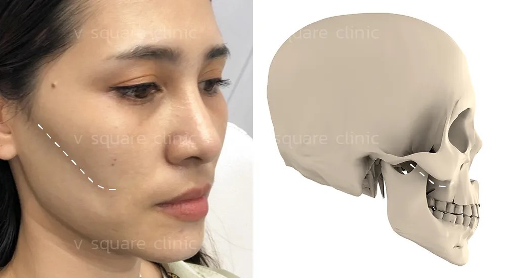 ฟิลเลอร์แก้มตอบ คืออะไร ฟิลเลอร์แก้มตอบ คืออะไร