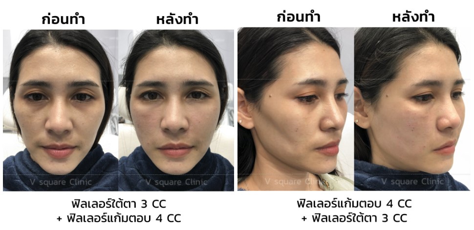 รีวิวฉีดฟิลเลอร์แก้มตอบ