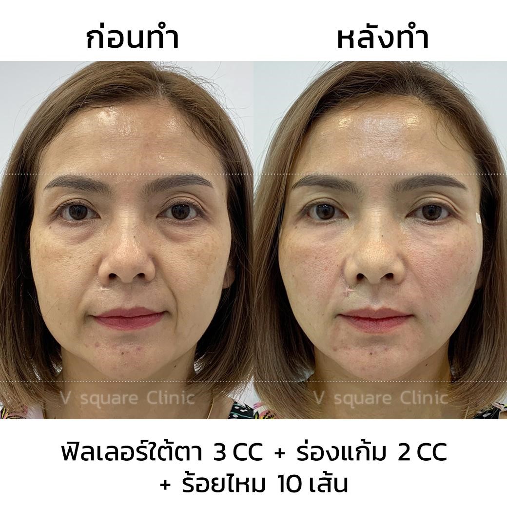 กระบวนการทำงานของการร้อยไหม ได้ผลจริงไหม กระบวนการทำงานของการร้อยไหม ได้ผลจริงไหม