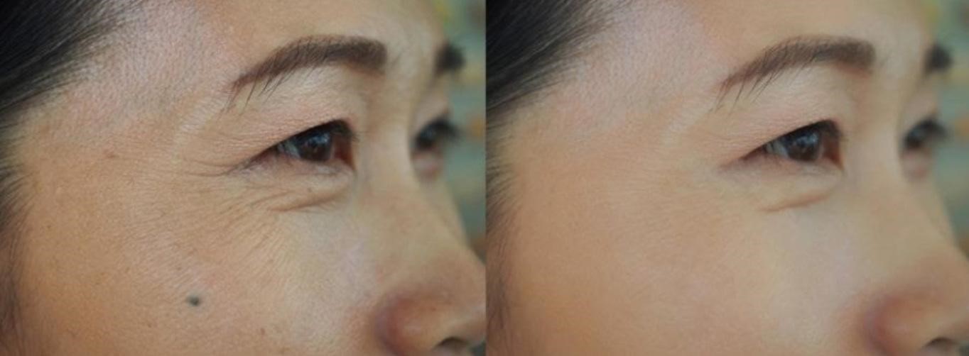 ฉีดโบท็อกหางตา ฉีดโบท็อกหางตา