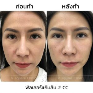 รีวิวฟิลเลอร์แก้มส้ม