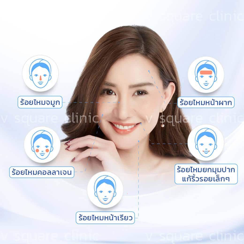 ร้อยไหม ตำแหน่งไหนได้บ้าง ร้อยไหม ตำแหน่งไหนได้บ้าง