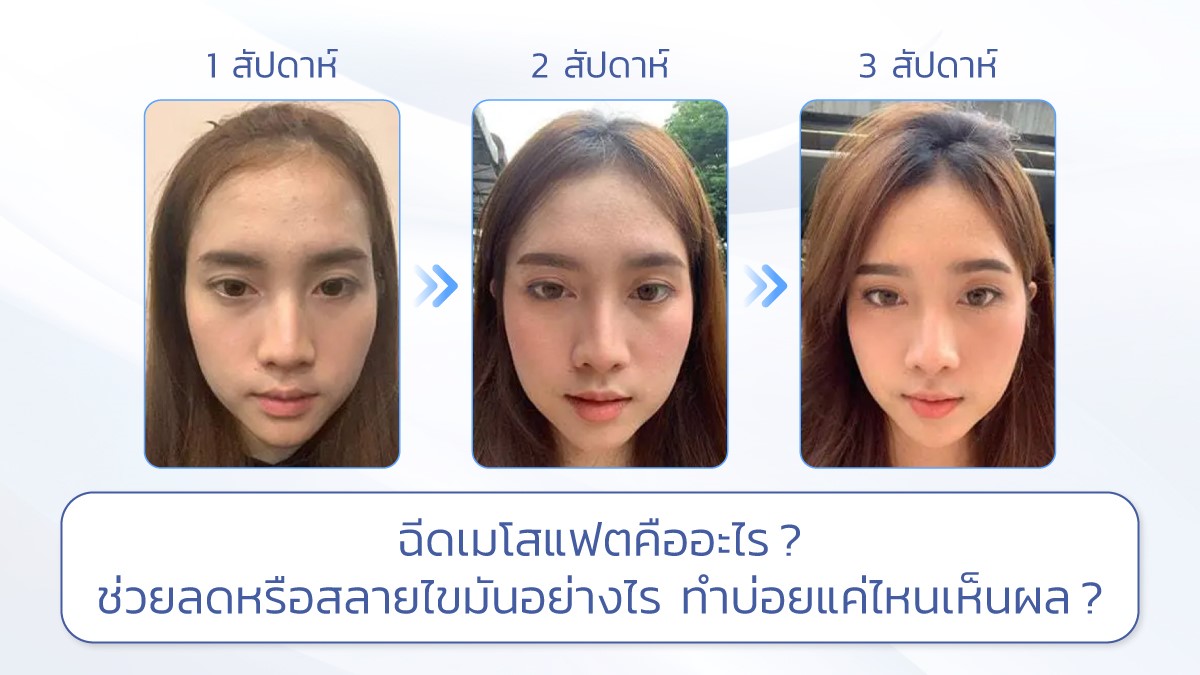 ฉีดเมโสแฟตคืออะไร ช่วยลดหรือสลายไขมันได้อย่างไร ทำบ่อยแค่ไหนเห็นผล ?