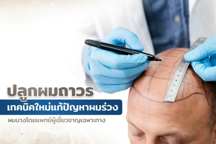 ปลูกผม ปลูกผม