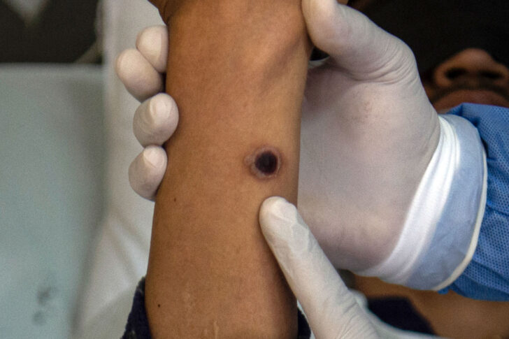 ฝีดาษลิง Monkeypox MPOX ฝีดาษลิง Monkeypox MPOX