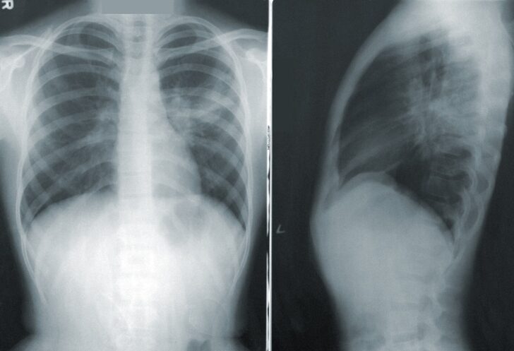 cdc-unsplash Xray