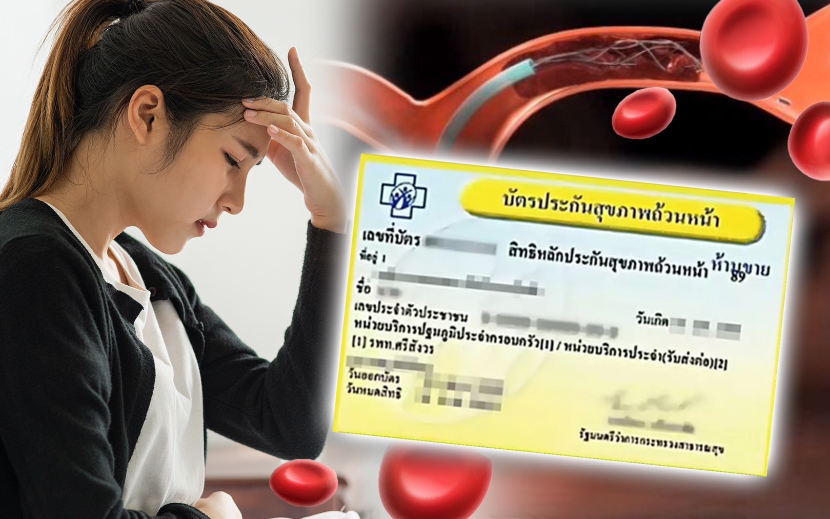 บัตรทองเพิ่มสิทธิรักษาด้วยการสวนหลอดเลือดสมอง